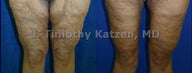 Thigh Lift after massive weight loss