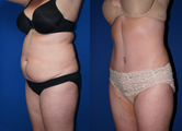 Smart Lipo of abdomen and tummy tuck