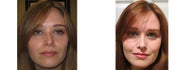 Mole Removal photos