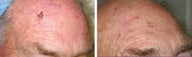 Mole Removal photos