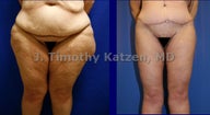 Leg Lift after weight loss surgery