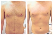Laser Hair Removal of Male Chest and Abdomen