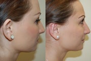 Otoplasty Surgery