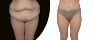 30 year old tummy tuck after 100 pound weight loss
