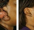 Keloid Removal Before & After