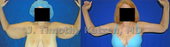 Arm Lift after massive weight loss