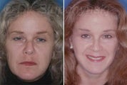 Facelift