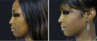 Nose Surgery