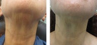 Female Ultherapy Treatment for Neck