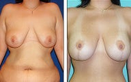 Breast Lift- Mastopexy
