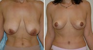 Mommy makeover - mastopexy + tummytuck