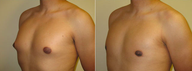 Male Breast Reduction