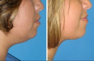 Chin liposuction