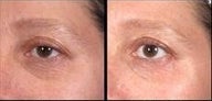 Ultherapy