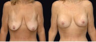 Breast lift with implants after weight loss