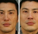 Male Patient Revision Rhinoplasty