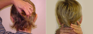 Otoplasty