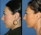 Revision Rhinoplasty