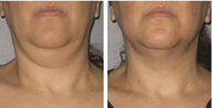 Ultherapy