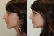 Rhinoplasty Surgery. 1 month post-op.