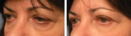 Female Blepharoplasty