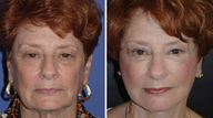 Facelift