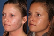 Before and After PDT