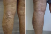 Varicose vein endovenous laser treatment