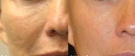 Sublative and ePrime for natural volume enhancement in cheeks