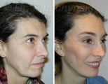 Facelift and Necklift
