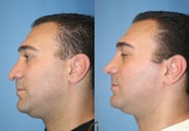 Revision rhinoplasty