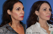 Laser Skin Resurfacing