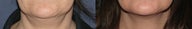 Ulthera Neck | Before and After