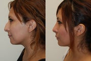Rhinoplasty Surgery. 5 weeks post-op.