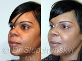 Revision Rhinoplasty