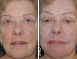 Laser Resurfacing