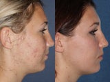 PDT & Fraxel Restore Before and After