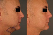Chin / Neck Liposuction