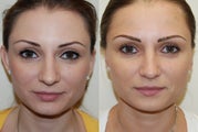 Otoplasty Surgery.