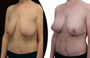 30 year old woman after 100 pound weight loss