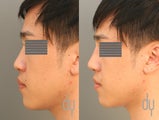 24 year old male before and after nonsurgical Asian rhinoplasty.