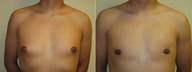 Male Breast Reduction