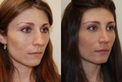 Rhinoplasty Surgery. 6 months post-op.