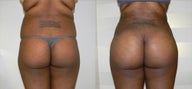 Body Sculpting with a Brazilian Butt Lift