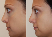 Non-Surgical Nose Job