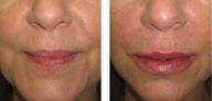 Restylane