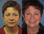 Eyelid Surgery