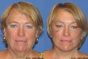 Laser Skin Resurfacing