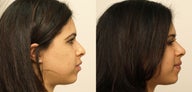 Rhinoplasty without surgery