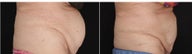 80-year-old woman had CoolSculpting for the protruding fat in the mid section of the abdomen.